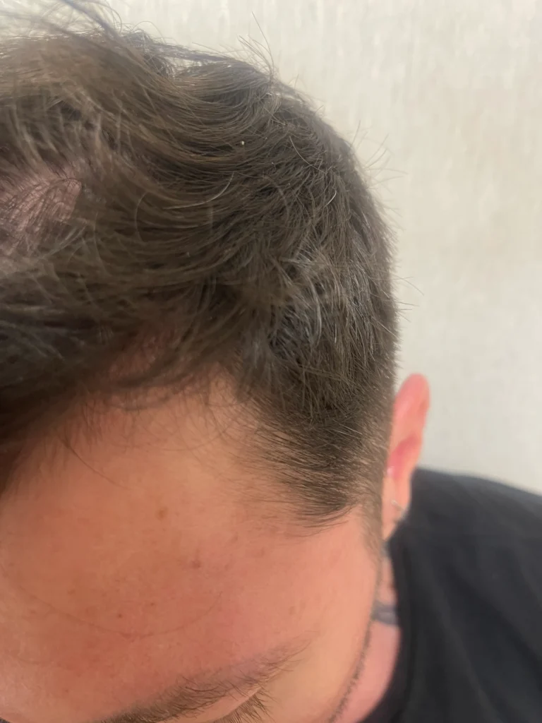 IMG 1649 1 PRP Hair Treatment