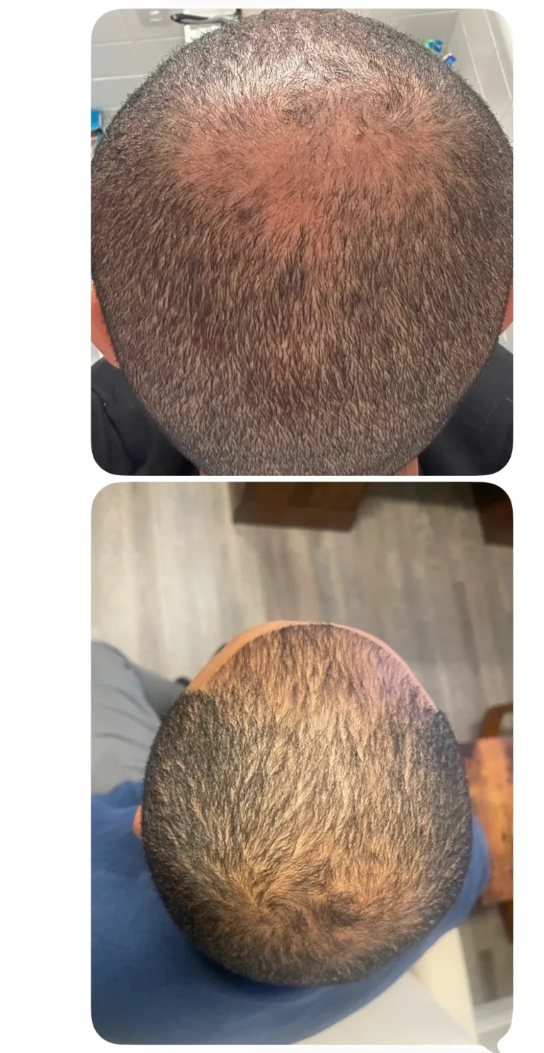 PRP Hair Restoration Alexandria VA