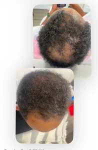 PRP Hair Treatment Alexandria VA