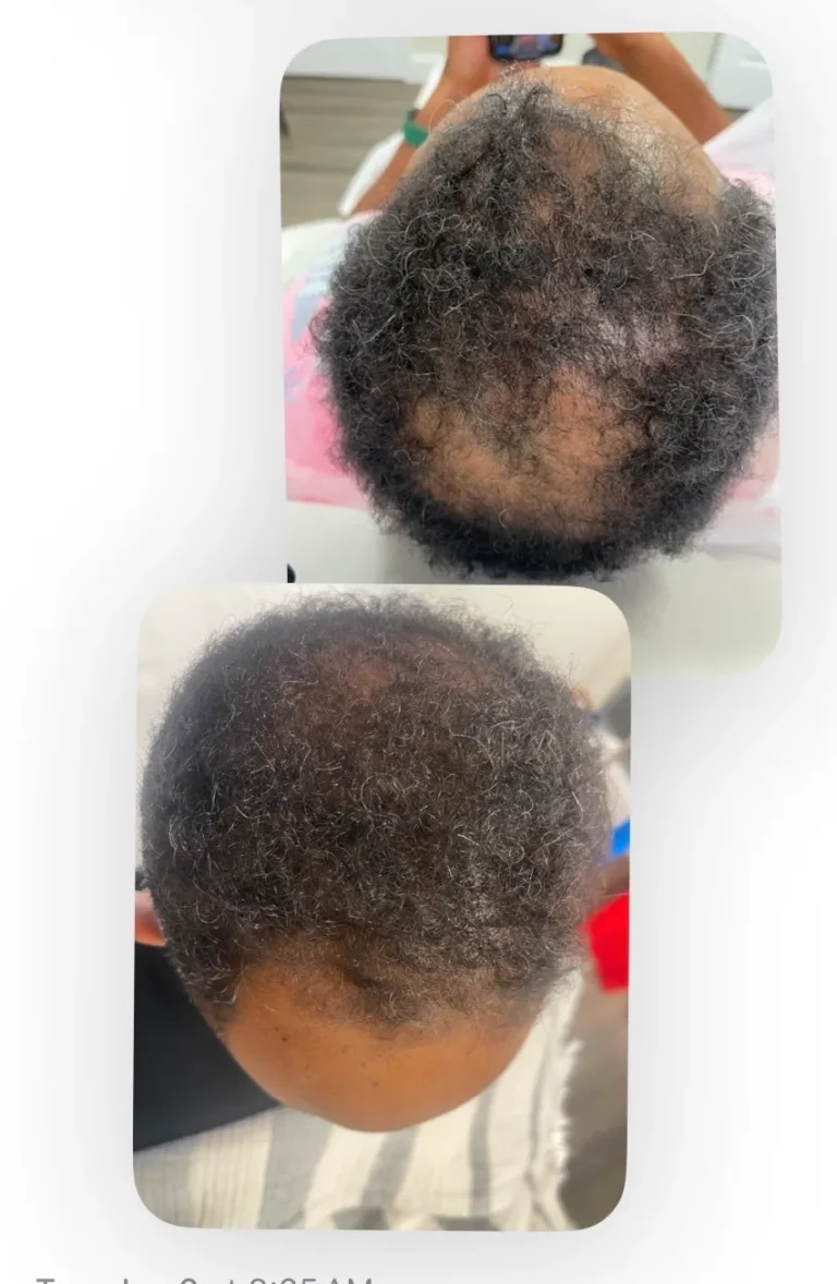 PRP Hair Treatment Alexandria VA