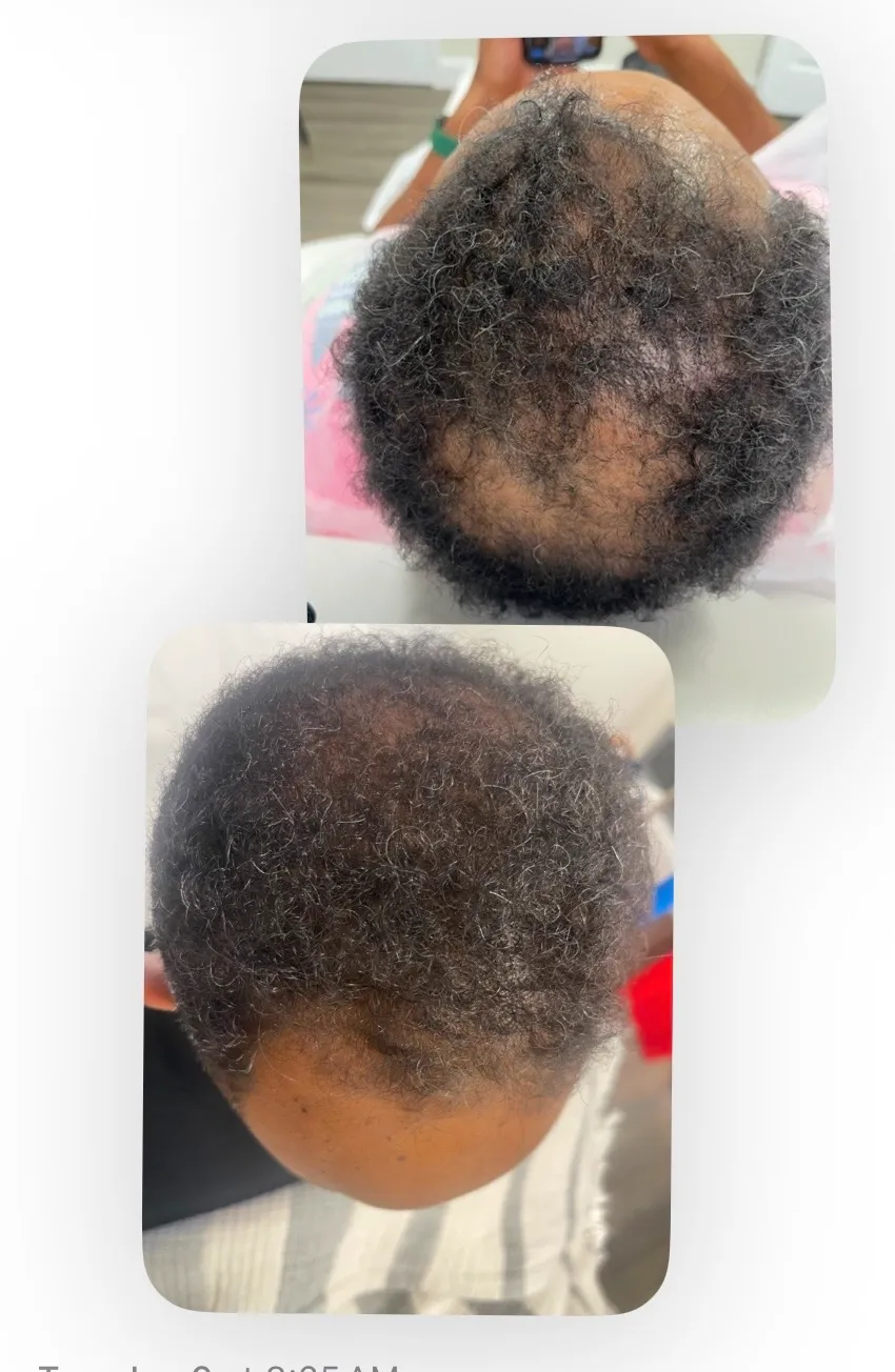 PRP Hair Treatment Alexandria VA